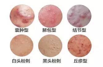 青春痘症状图片