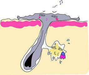 痤疮的主要症状