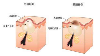 天津祛痘的方法